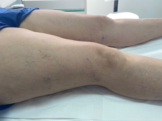 Clinica para Tratamento de Vasinhos em Sorocaba Imagem