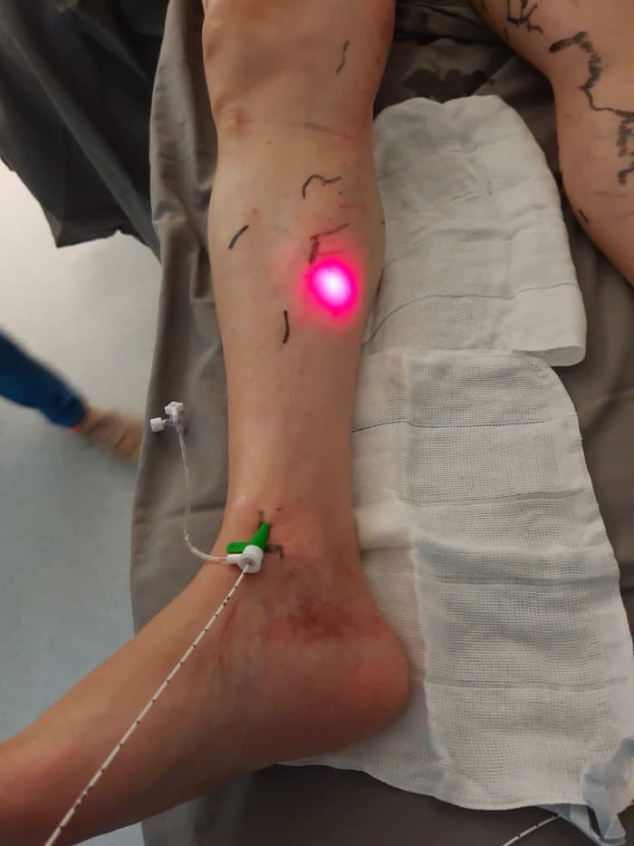 Tratamento a Laser para Varizes em Tatuí